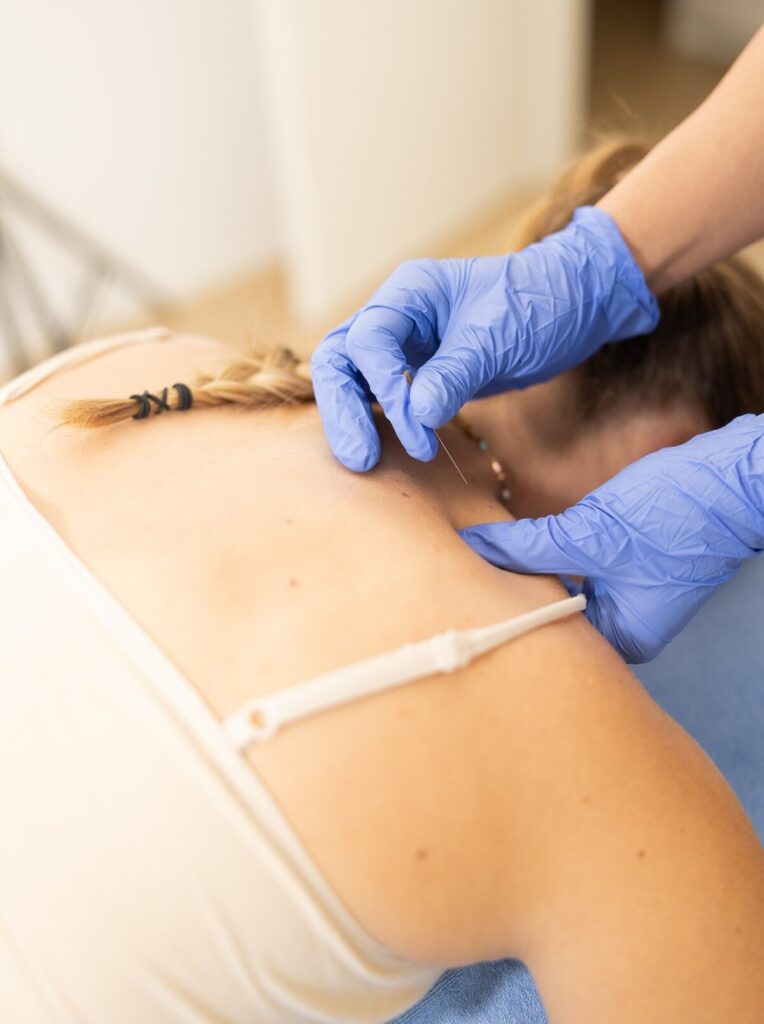 dry needling